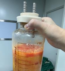 齐河水动力吸脂手术要做多久？